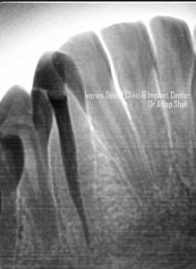 3D leak proof obturation